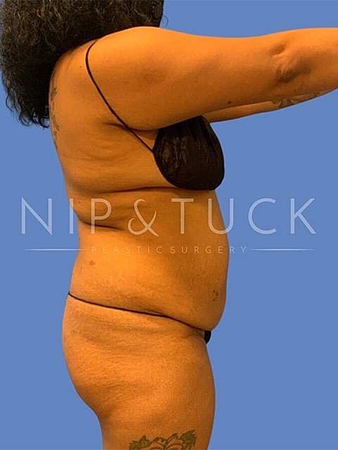 Abdominoplasty Before & After