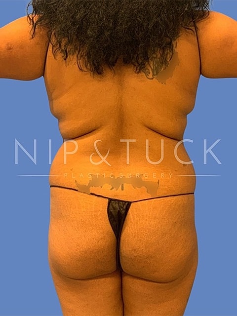 Abdominoplasty Before & After