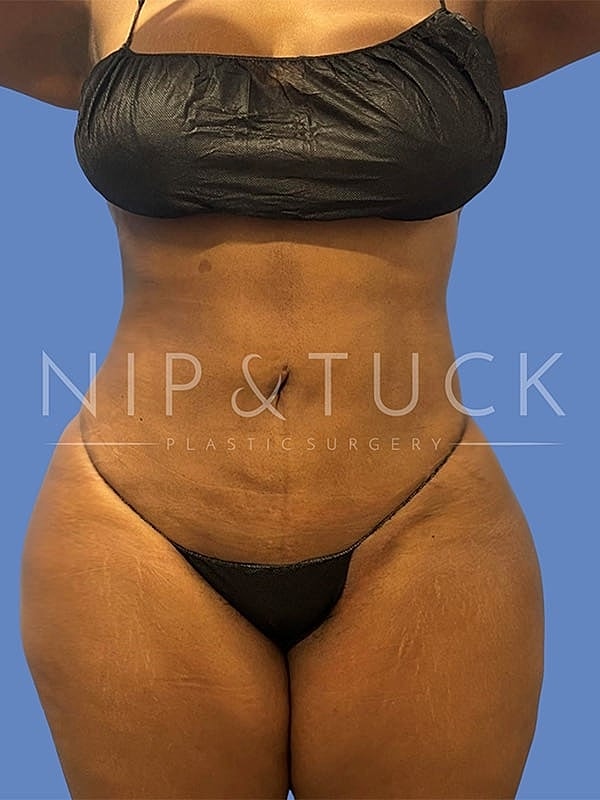 Abdominoplasty Before & After