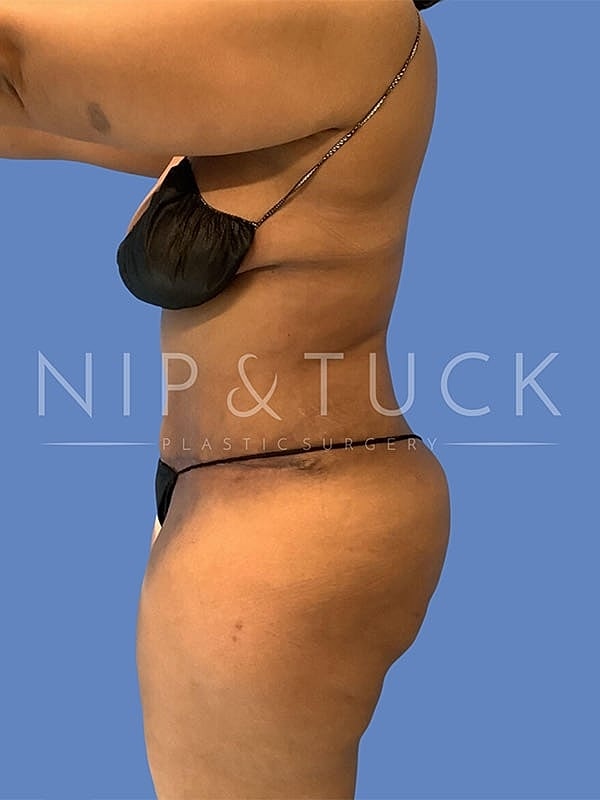 Abdominoplasty Before & After