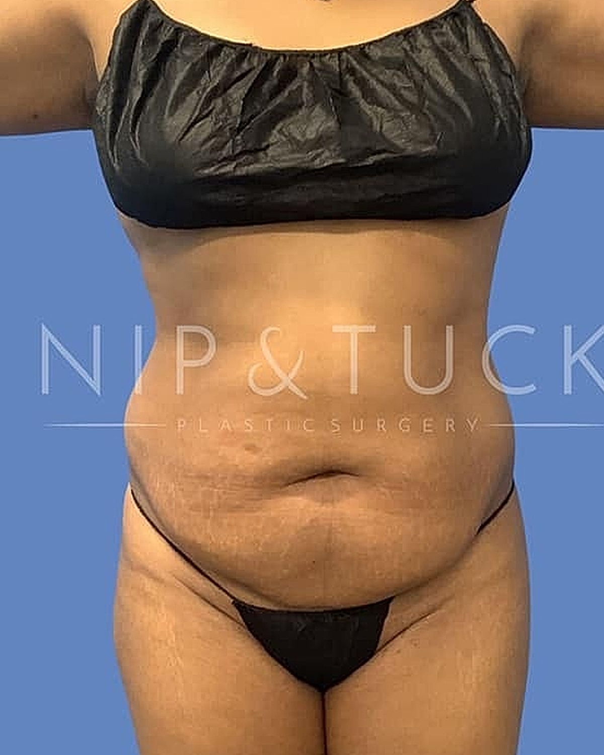 Abdominoplasty Before & After