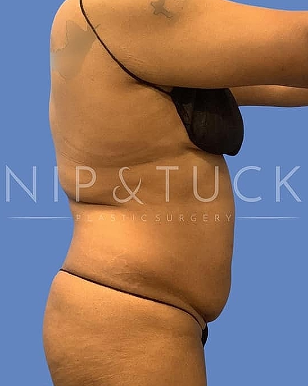 Side view of body before plastic surgery.