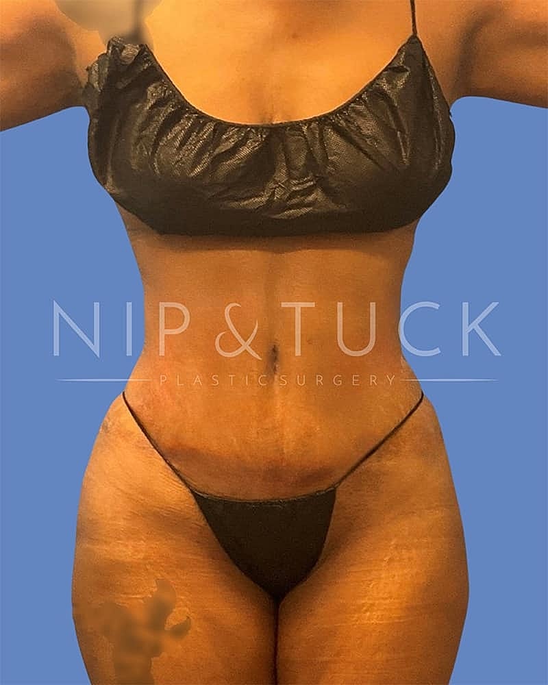 Abdominoplasty Before & After