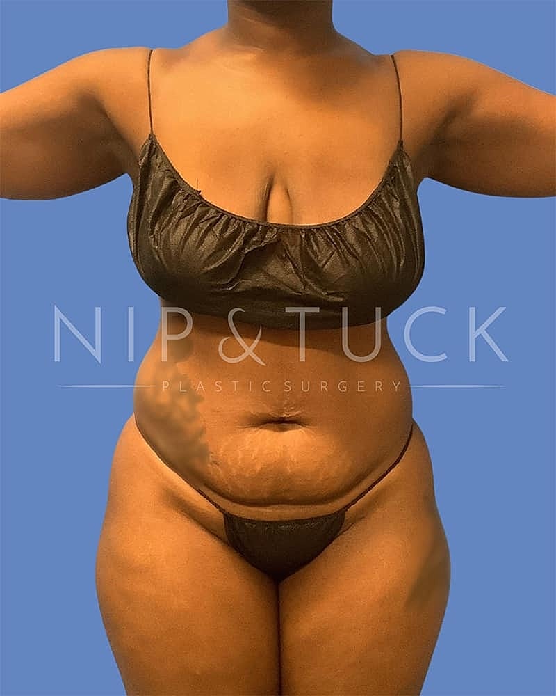Abdominoplasty Before & After