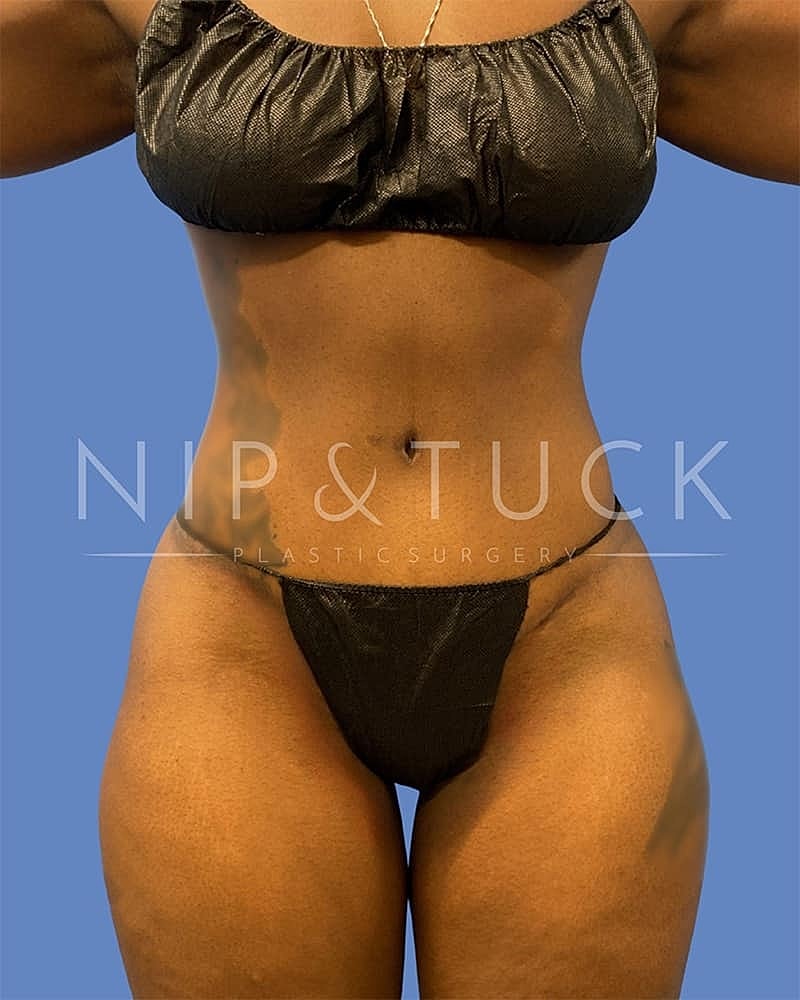 Abdominoplasty Before & After