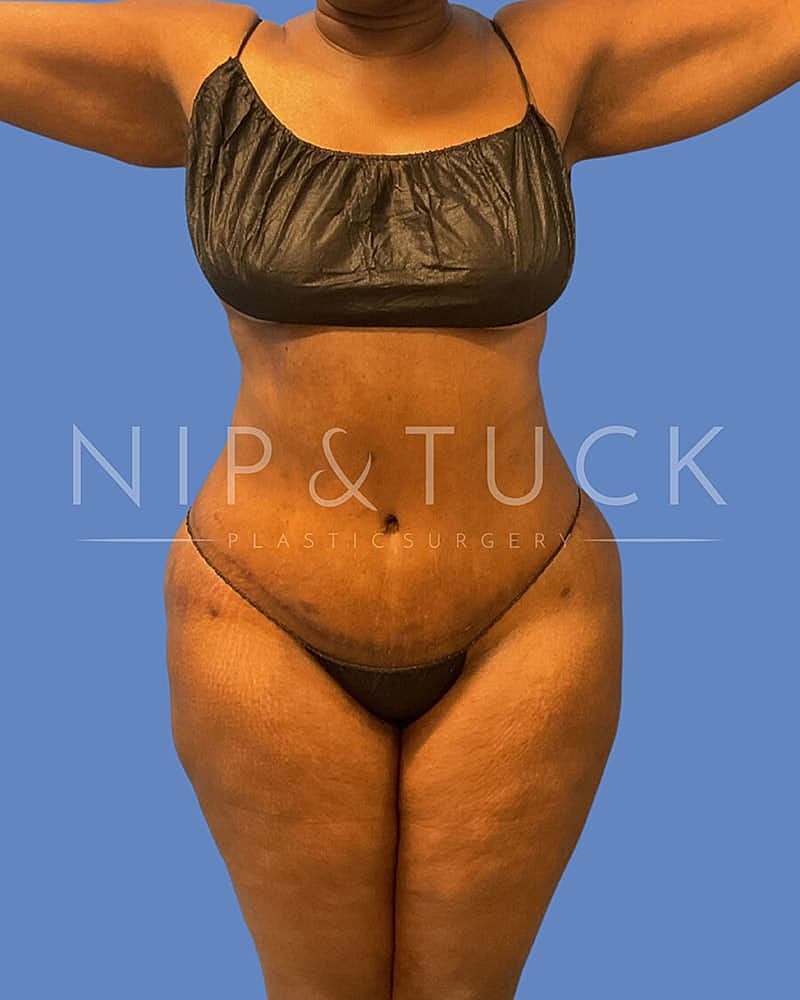 Abdominoplasty Before & After