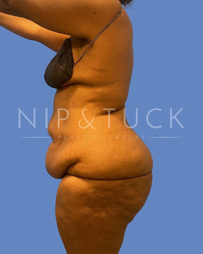 Abdominoplasty Before & After