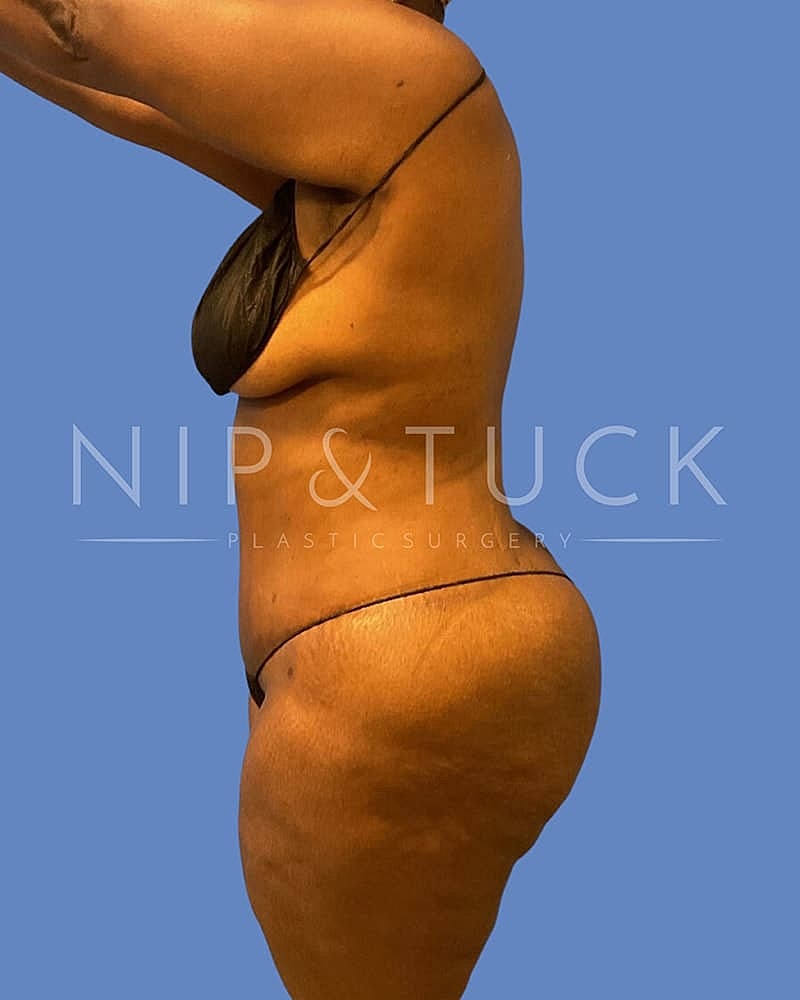 Abdominoplasty Before & After