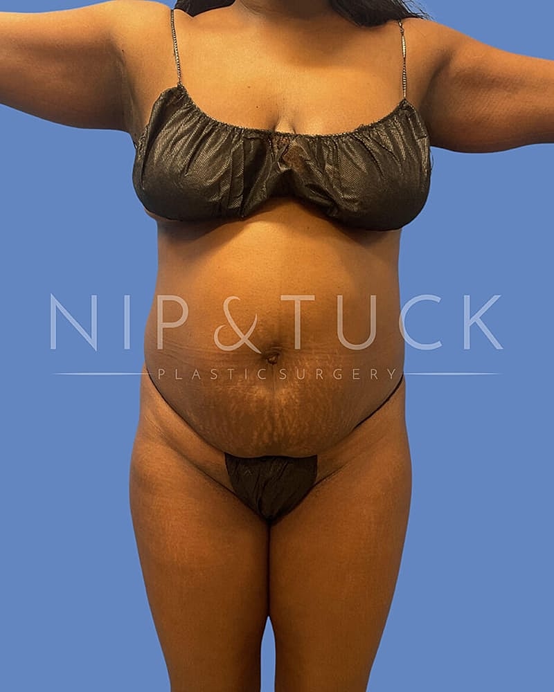 Abdominoplasty Before & After