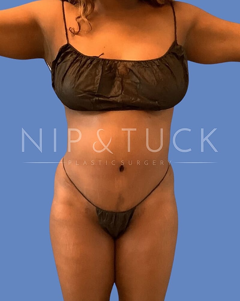 Abdominoplasty Before & After