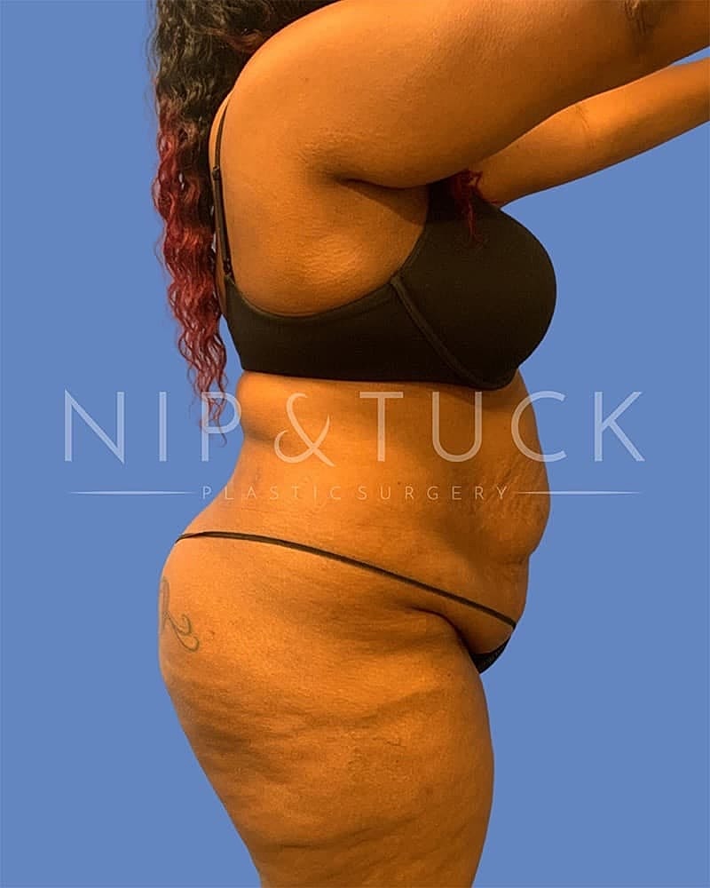 Abdominoplasty Before & After