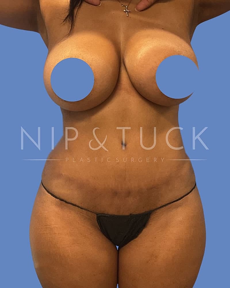 Abdominoplasty Before & After