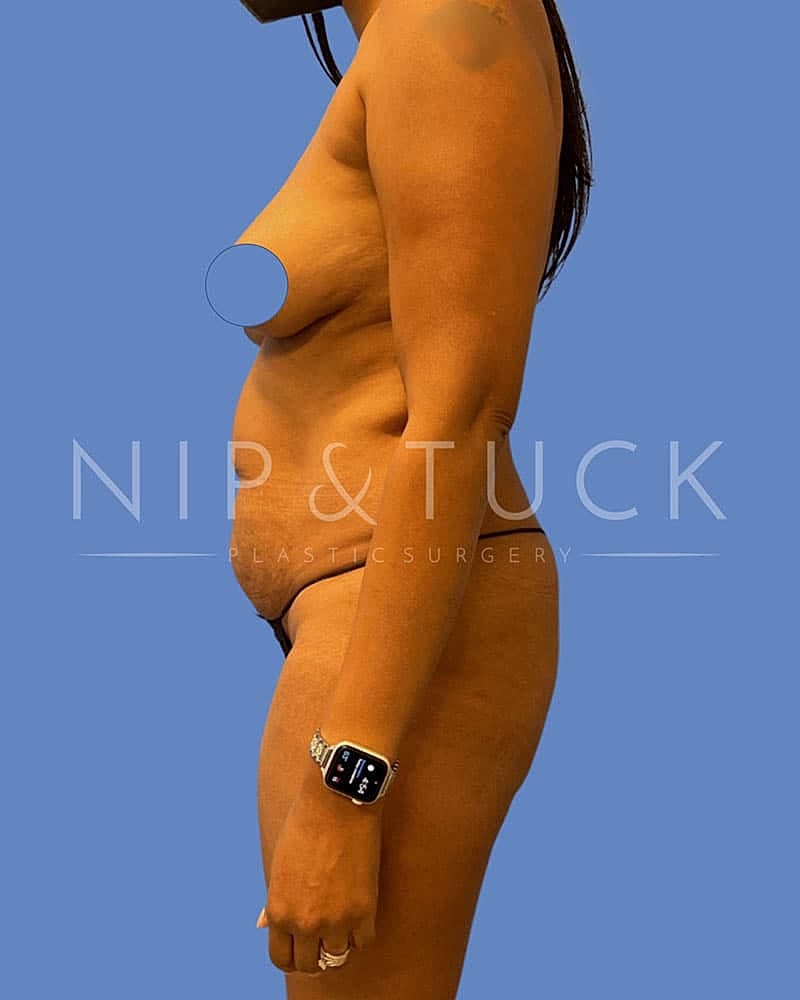 Abdominoplasty Before & After