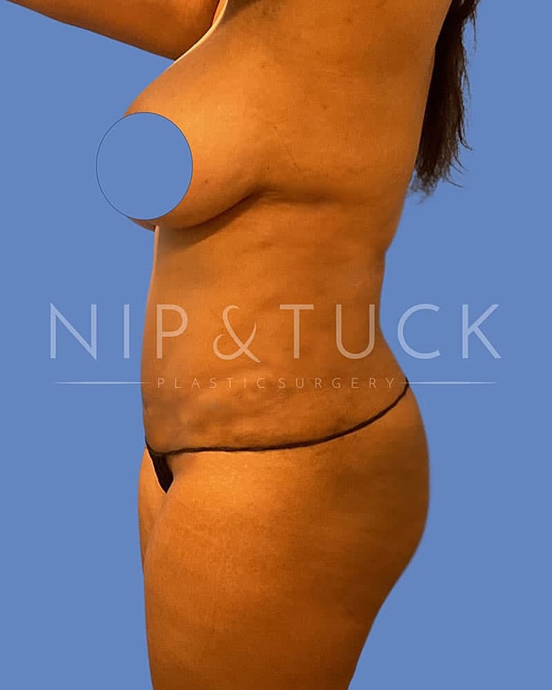 Abdominoplasty Before & After