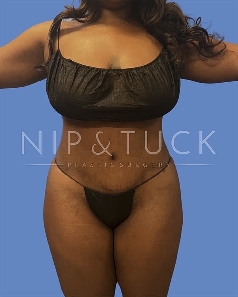 Abdominoplasty Before & After