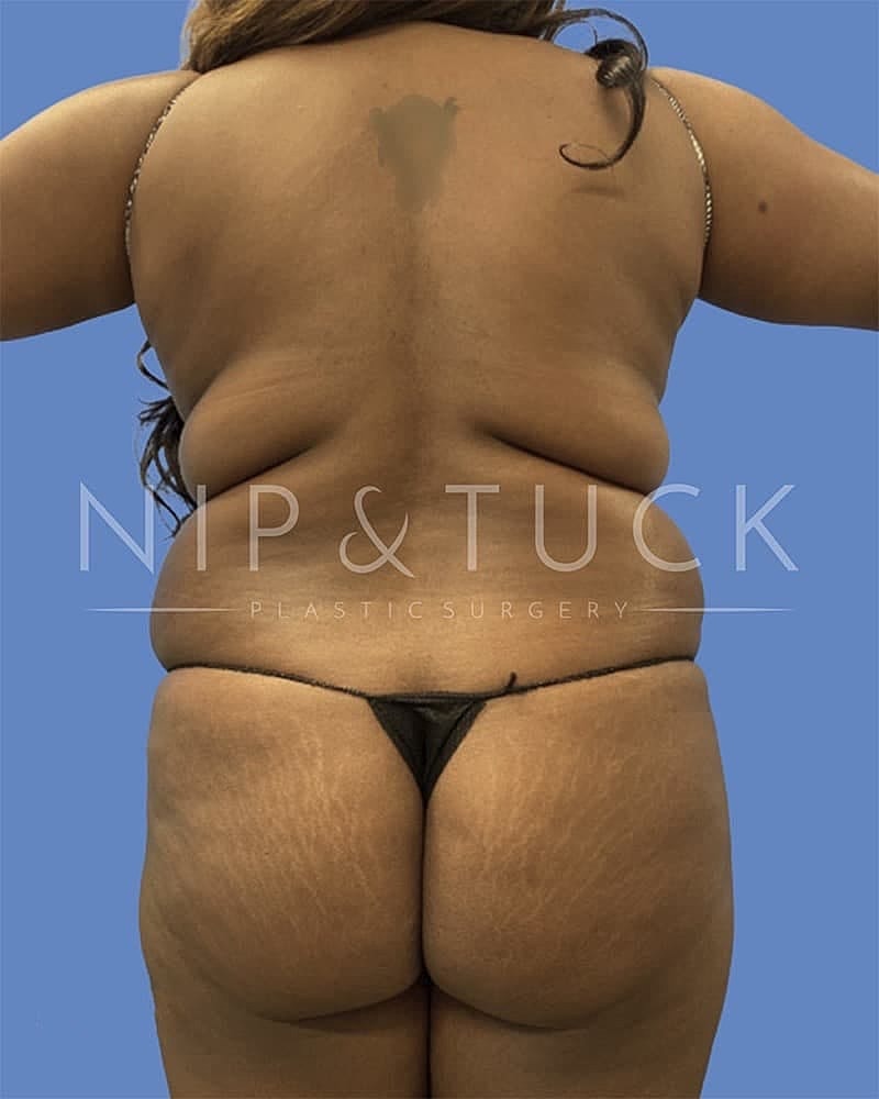 Abdominoplasty Before & After