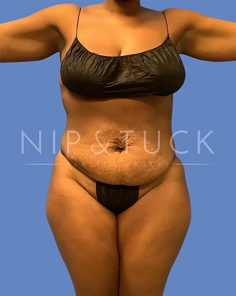 Abdominoplasty Before & After