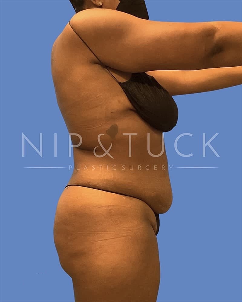 Abdominoplasty Before & After