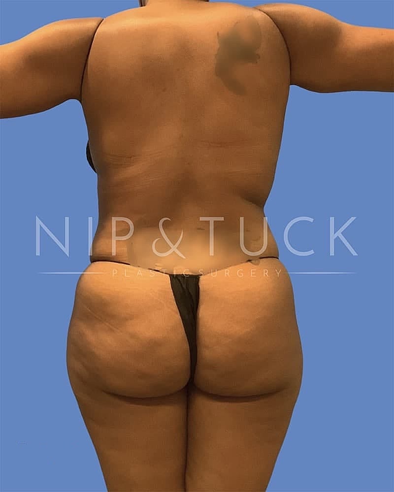 Abdominoplasty Before & After