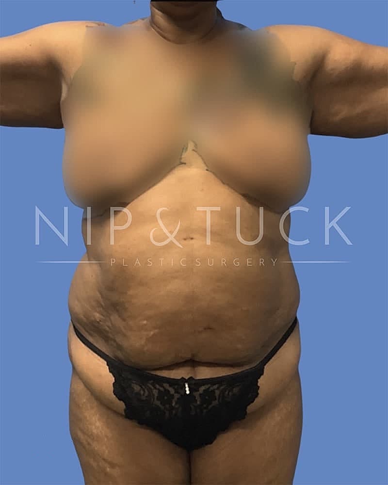 Abdominoplasty Before & After
