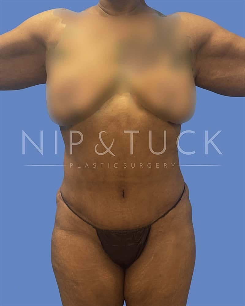 Abdominoplasty Before & After