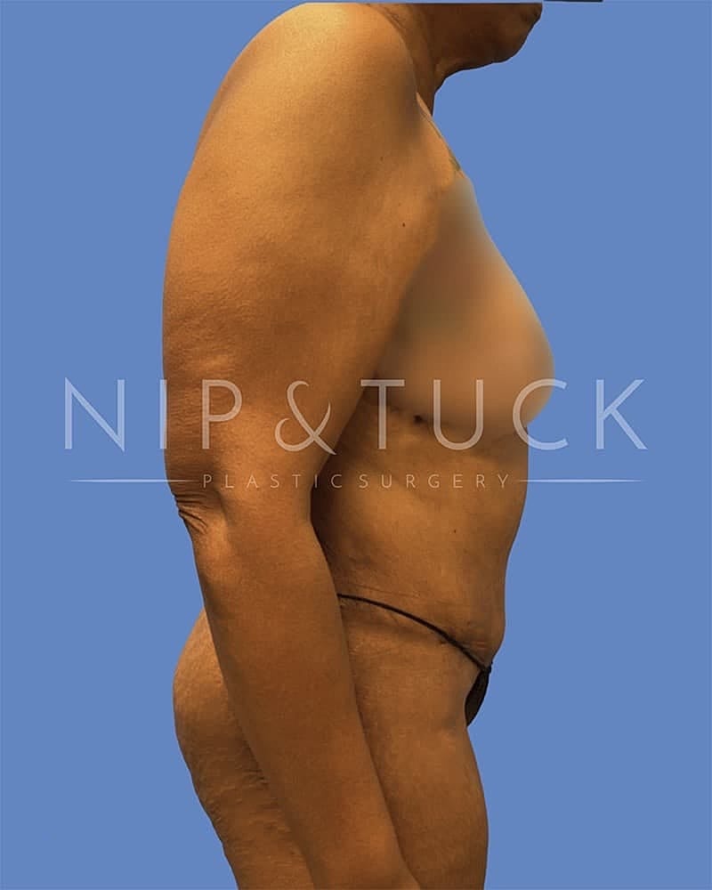 Abdominoplasty Before & After