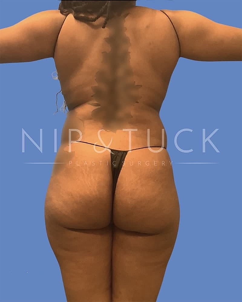 Abdominoplasty Before & After