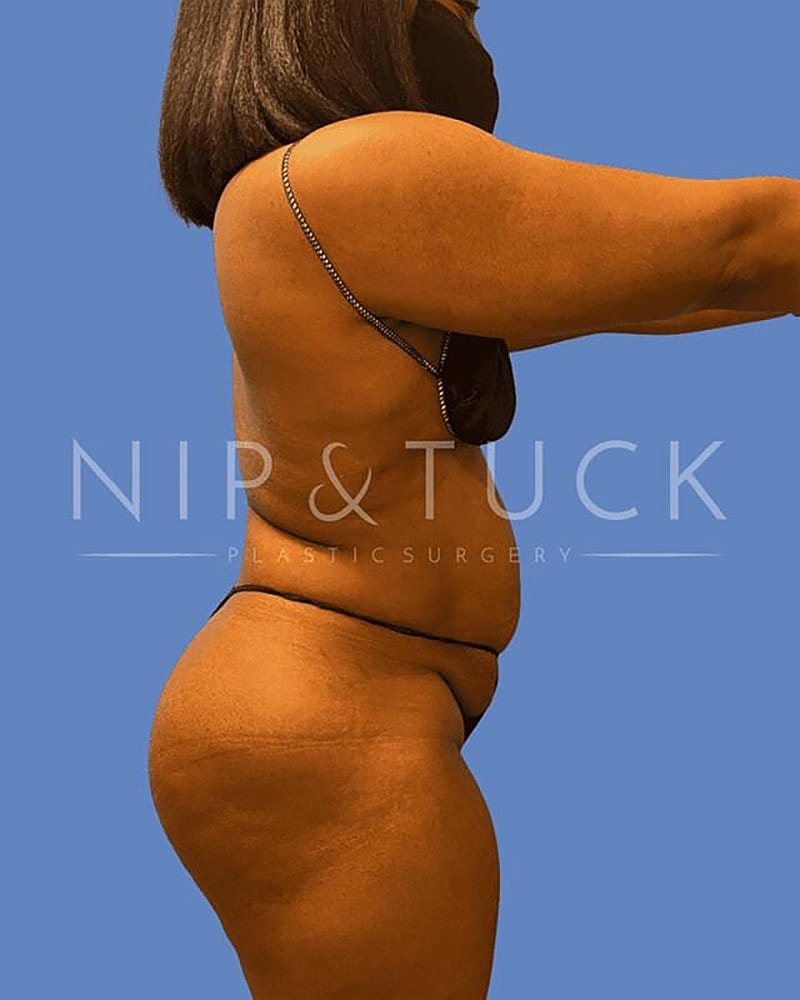 Abdominoplasty Before & After