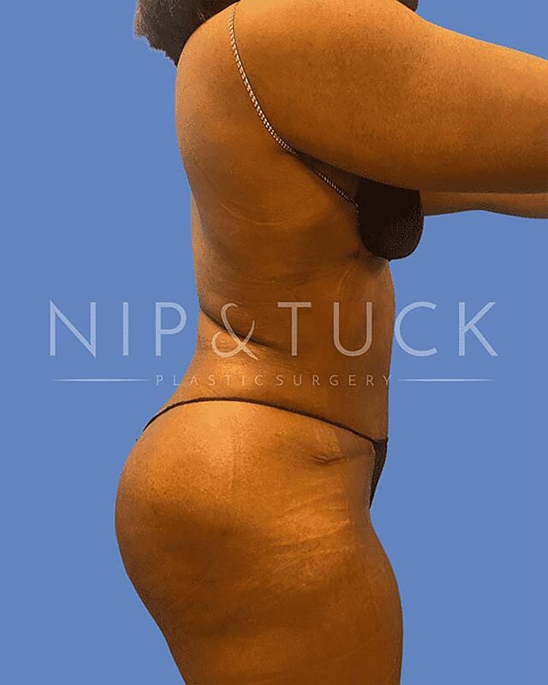 Abdominoplasty Before & After