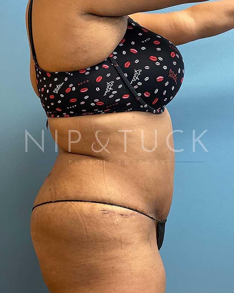 Abdominoplasty Before & After