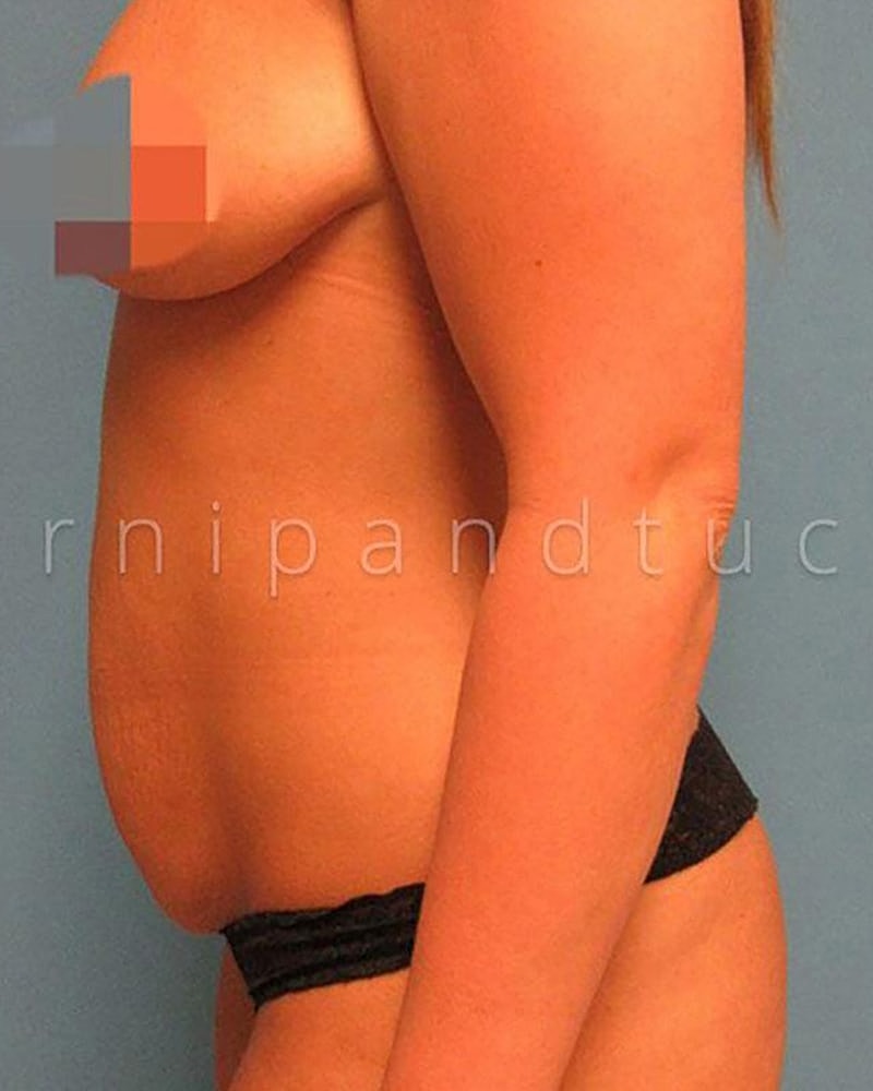 Abdominoplasty Before & After