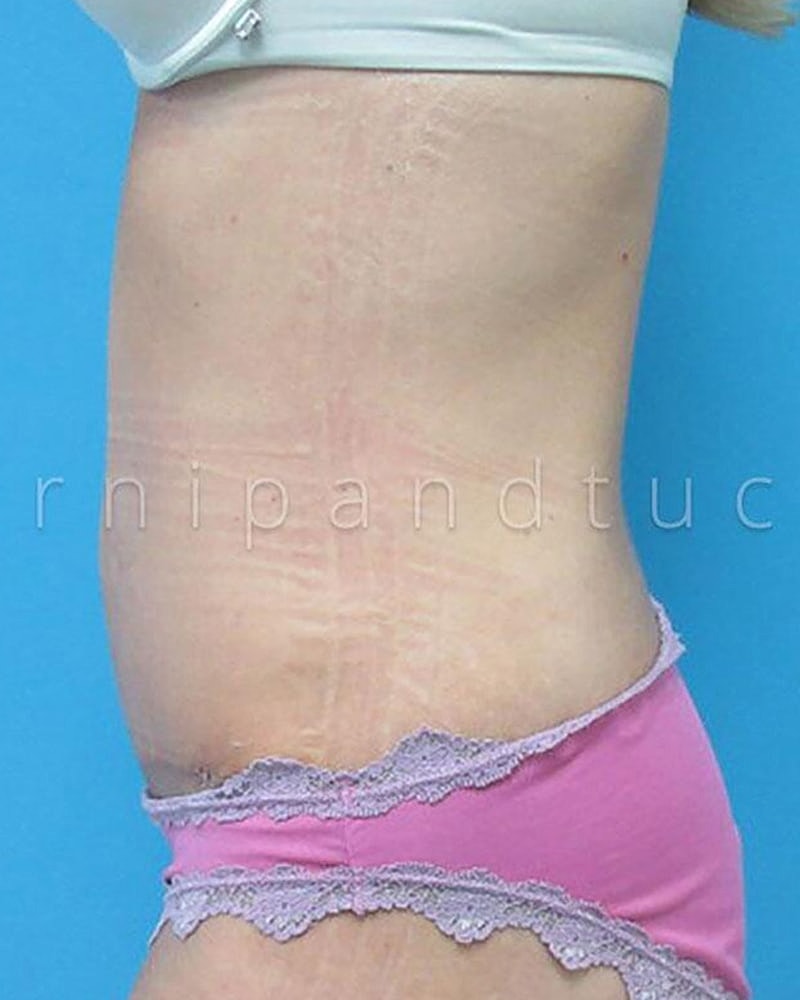 Abdominoplasty Before & After
