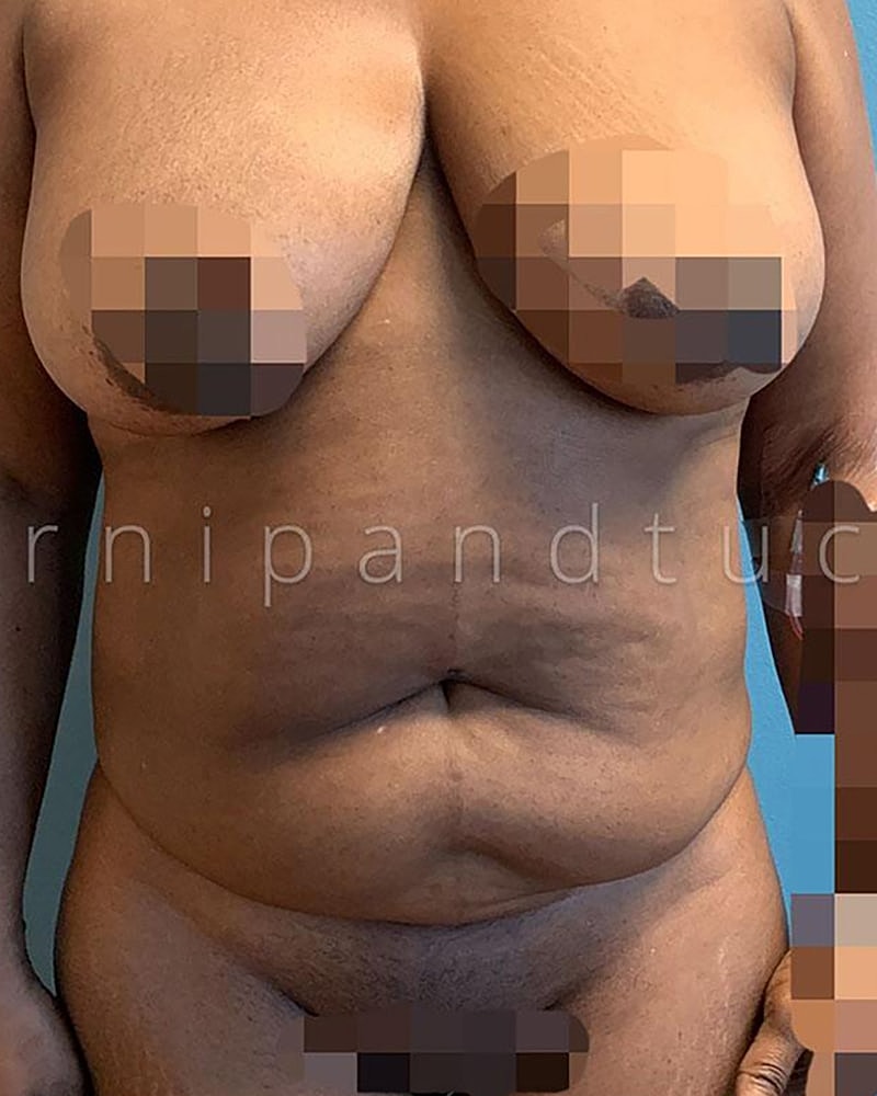 Abdominoplasty Before & After
