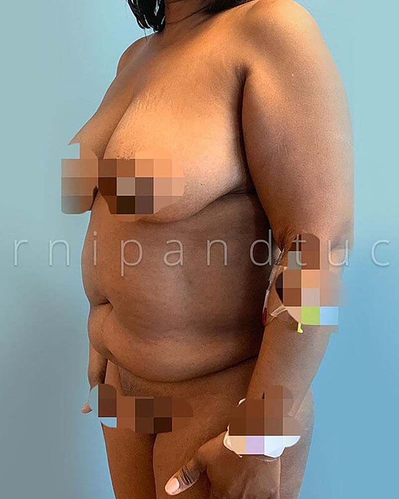Abdominoplasty Before & After