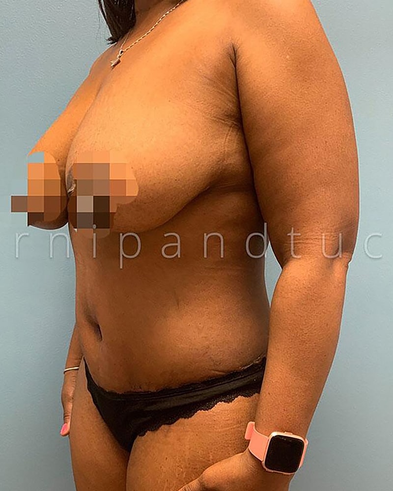 Abdominoplasty Before & After