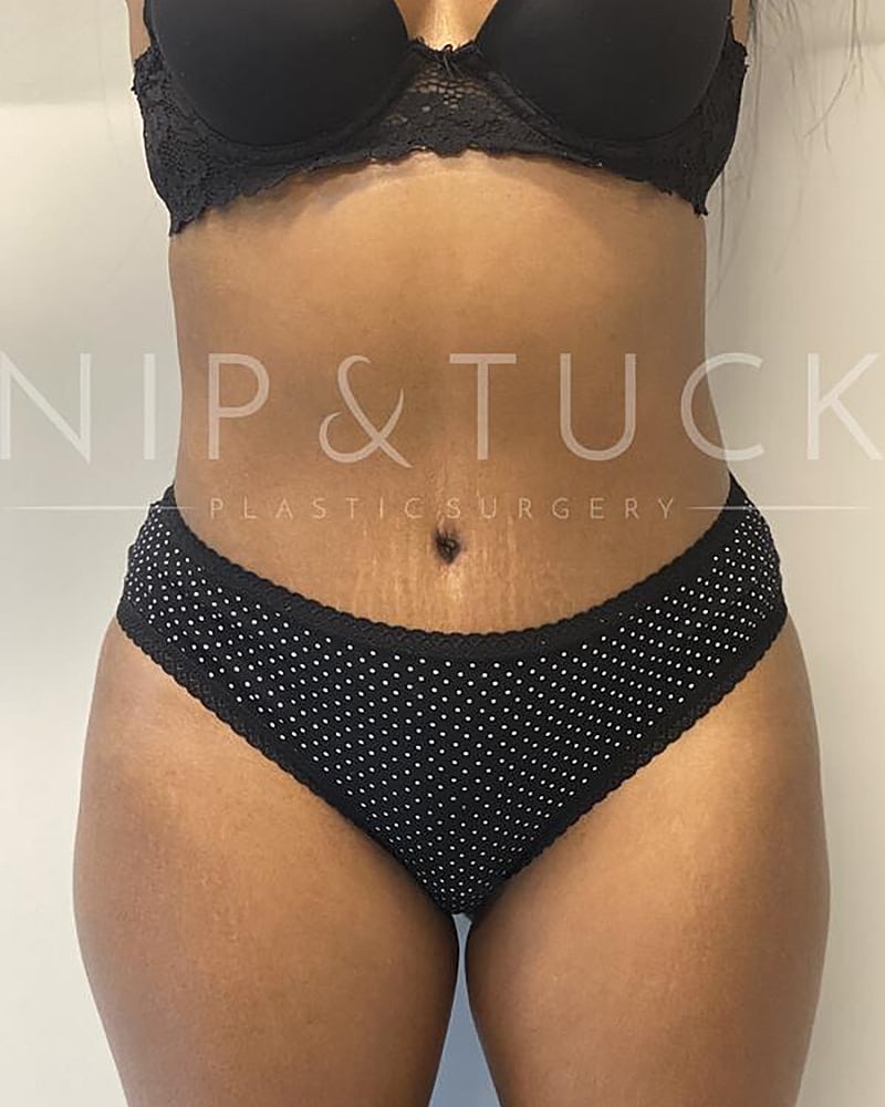 Abdominoplasty Before & After