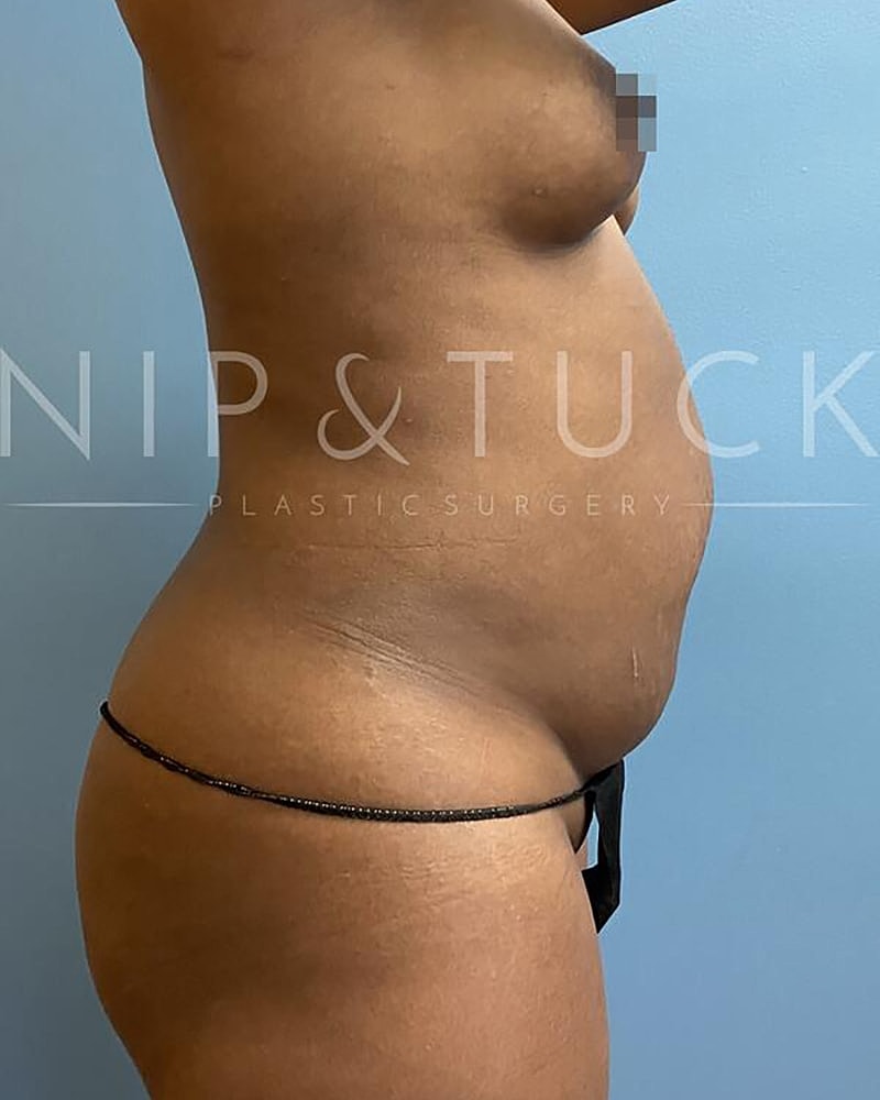 Abdominoplasty Before & After