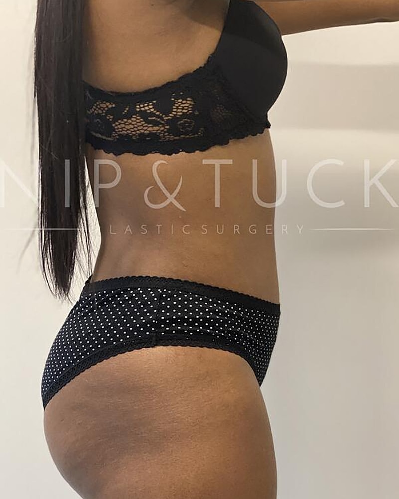 Abdominoplasty Before & After