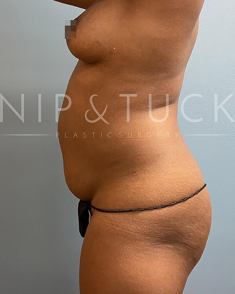 Abdominoplasty Before & After