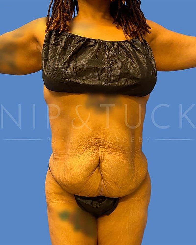 Abdominoplasty Before & After