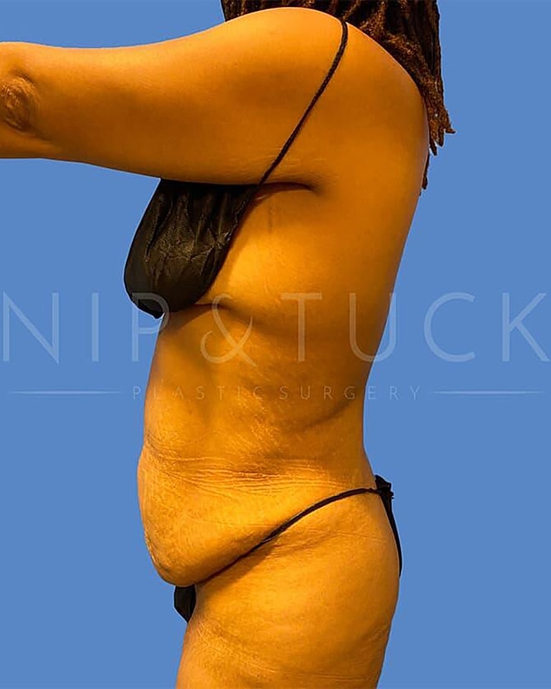 Abdominoplasty Before & After