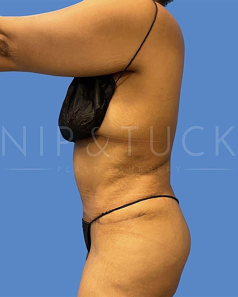 Abdominoplasty Before & After