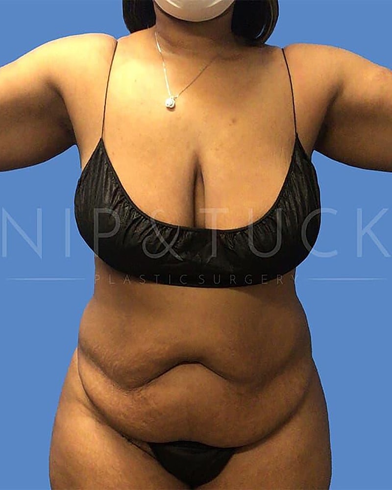 Abdominoplasty Before & After