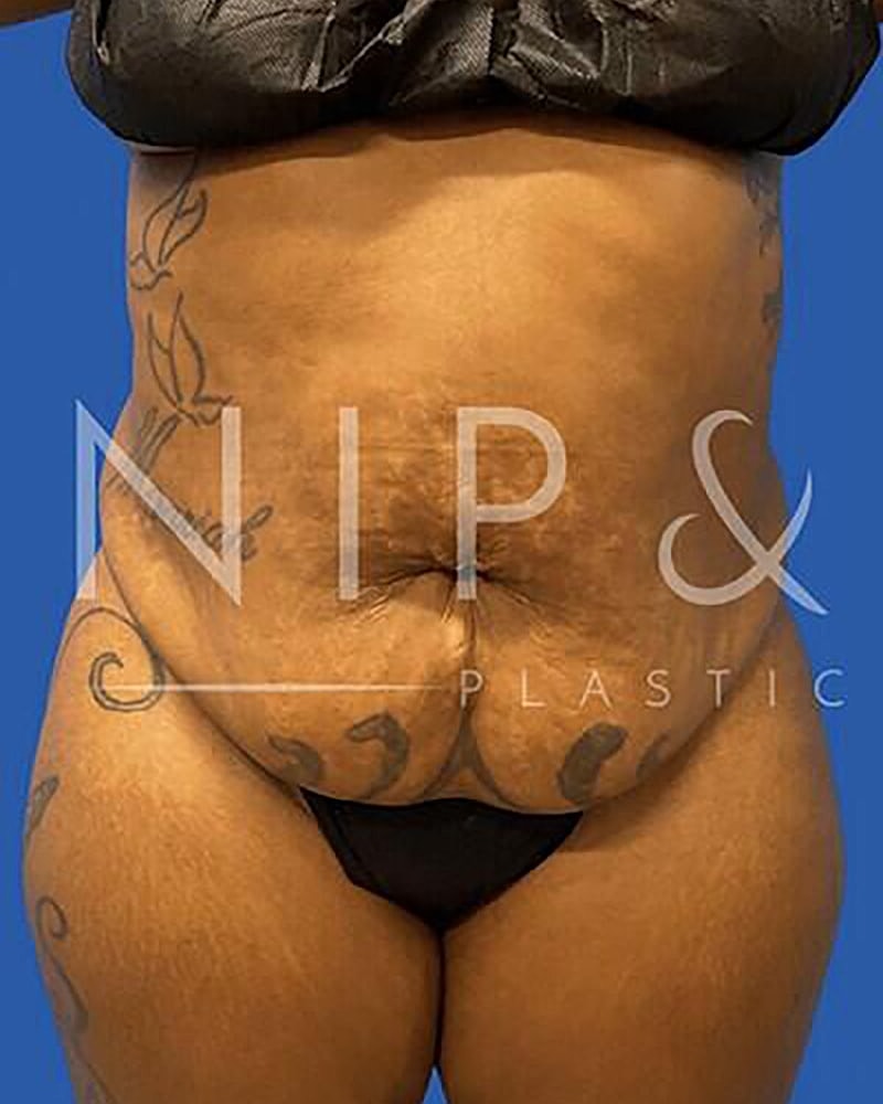 Abdominoplasty Before & After