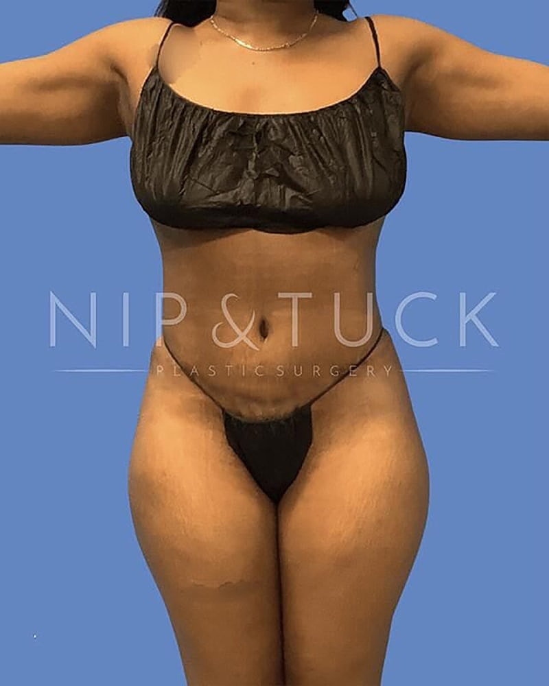 Abdominoplasty Before & After