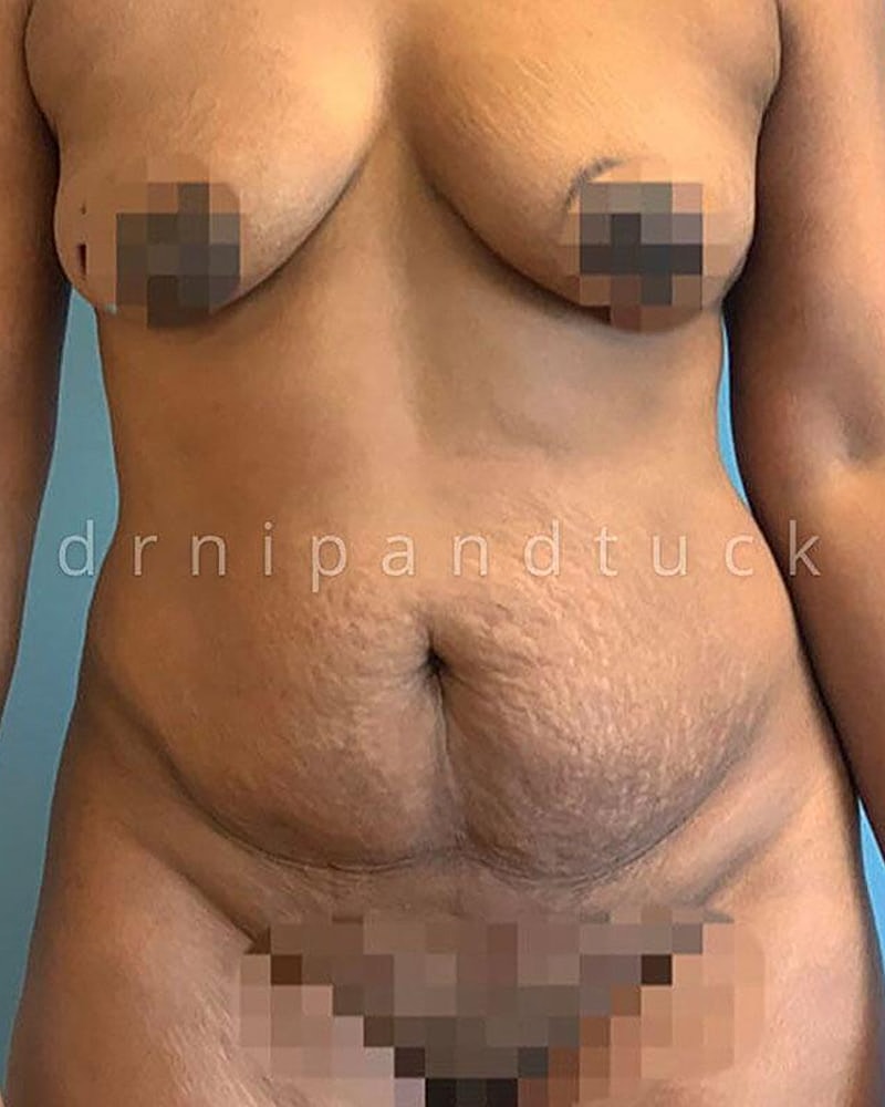 Abdominoplasty Before & After