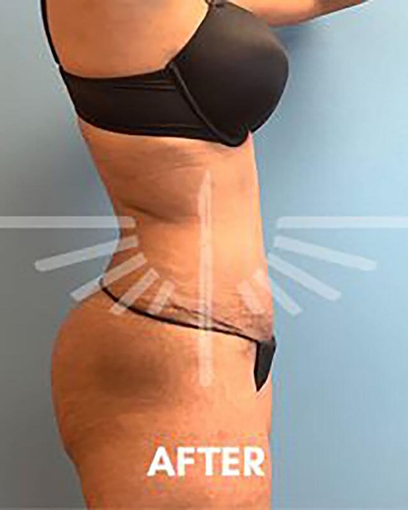 Abdominoplasty Before & After