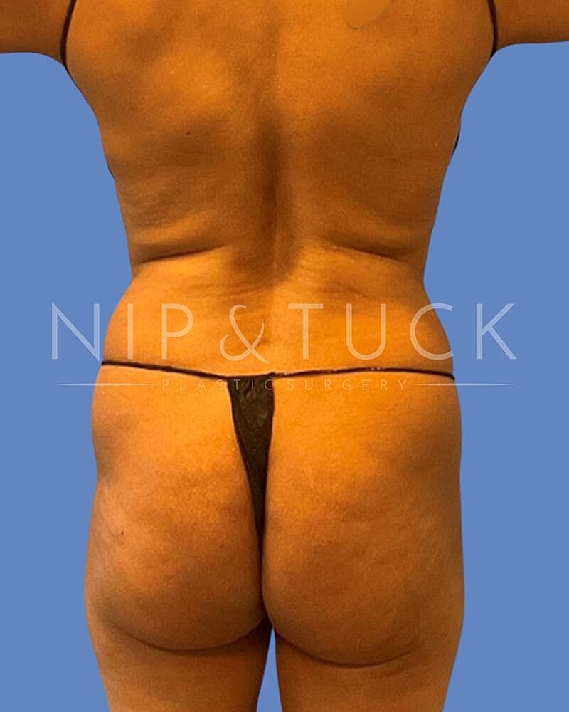 Abdominoplasty Before & After