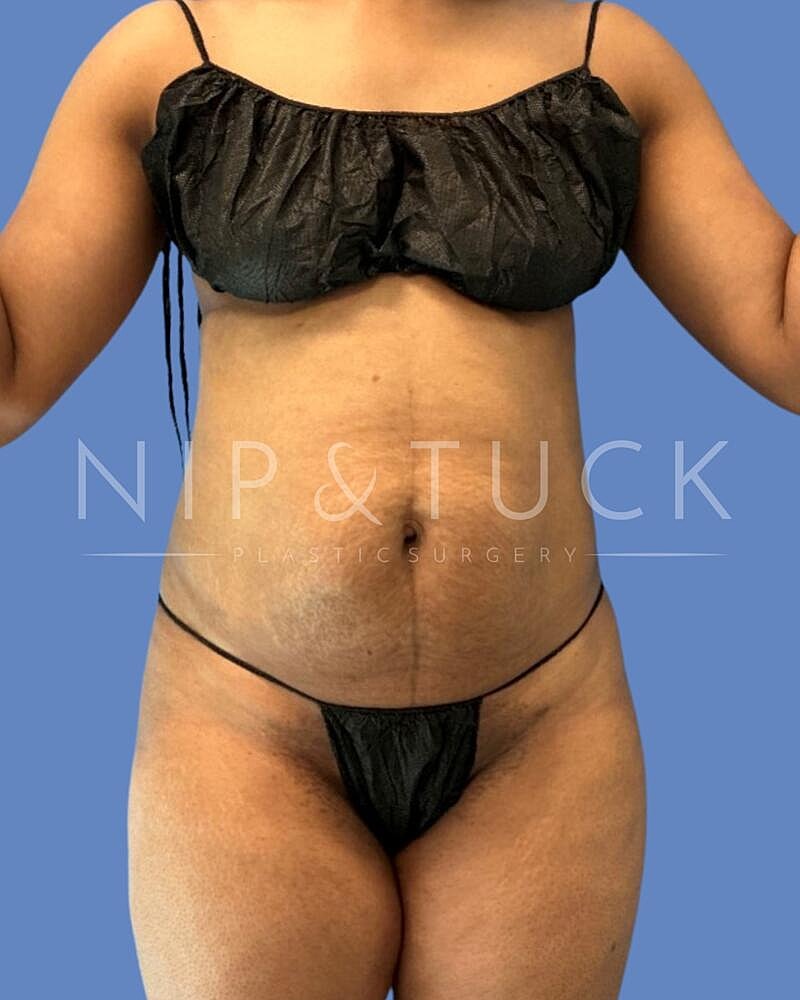 Abdominoplasty Before & After