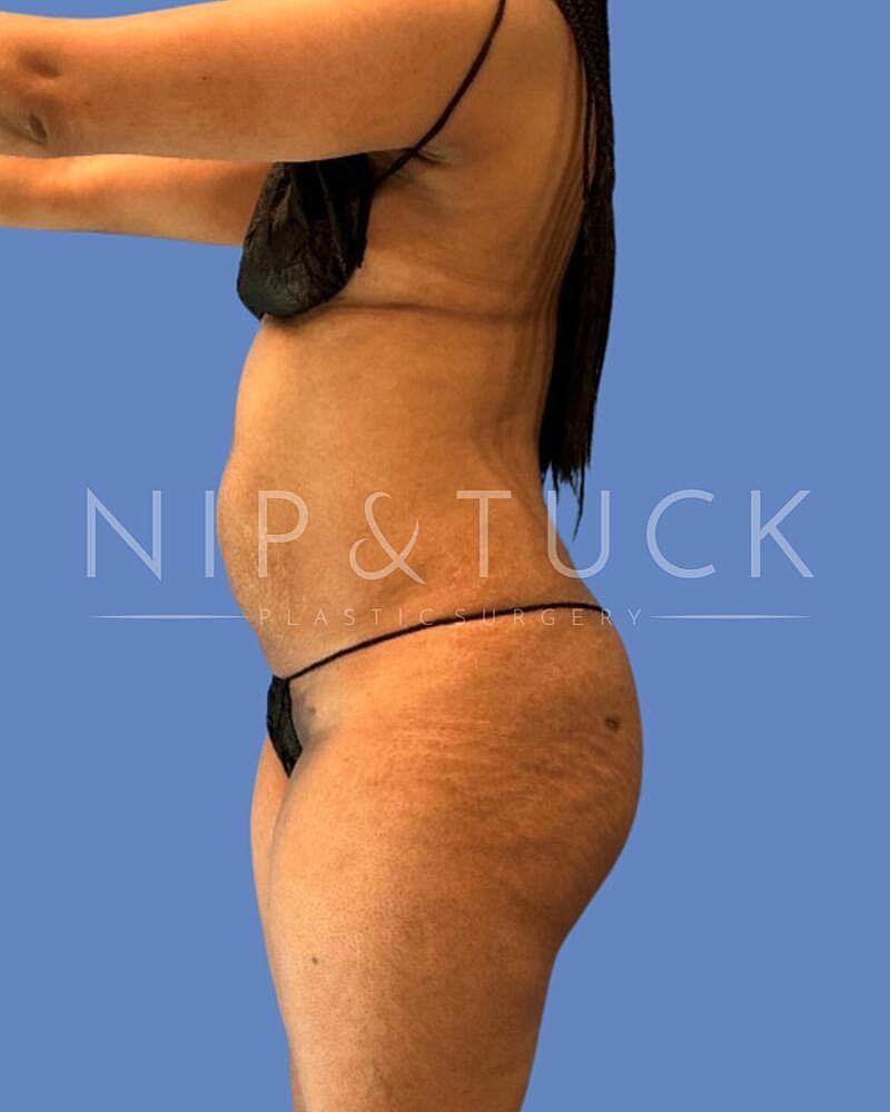 Abdominoplasty Before & After